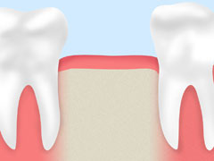 歯周病とはどんな病気？